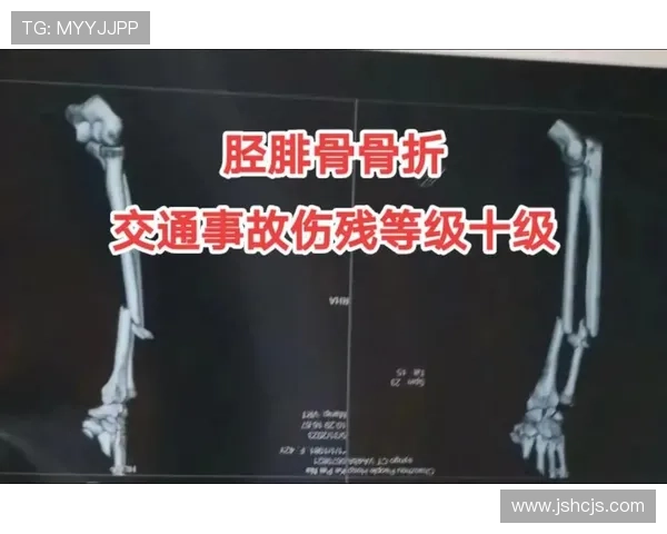 慎入!厄瓜多尔联赛球员双腿骨折事故 慎入!厄瓜多尔联赛球员双腿骨折事故